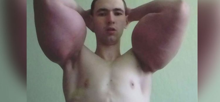 "Popeye": El fisicoculturista que se inyecta aceite en los brazos