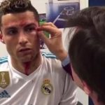 La cruda herida de Cristiano Ronaldo un día después
