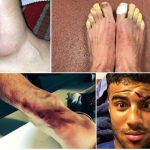 Las heridas que los futbolistas publican en sus redes sociales