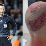Árbitro inglés se somete a impactante trasplante de pelo