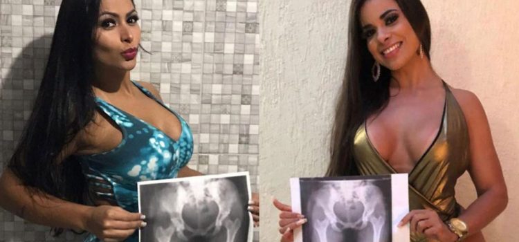Candidatas a Miss BumBum posan con sus radiografías para alertar contra las cirugías