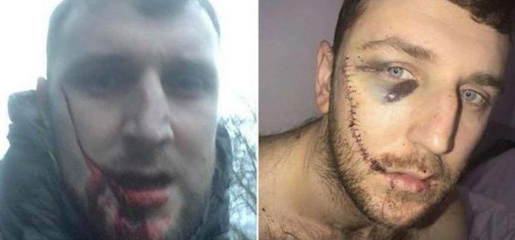 La herida de un "hooligan" del Everton tras una pelea con ultras del Millwall (VÍDEO)