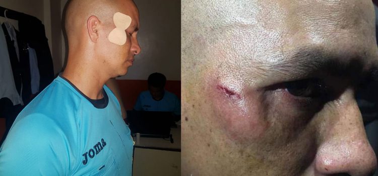 Así quedó el rostro del árbitro Gerson Matute